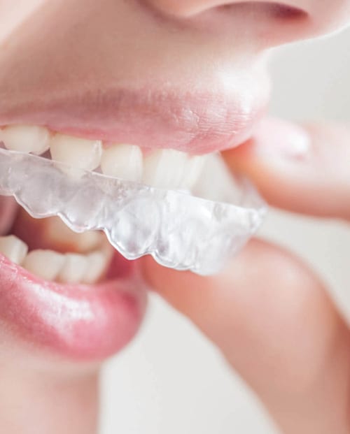 Invisalign System, Invisalign Springfield