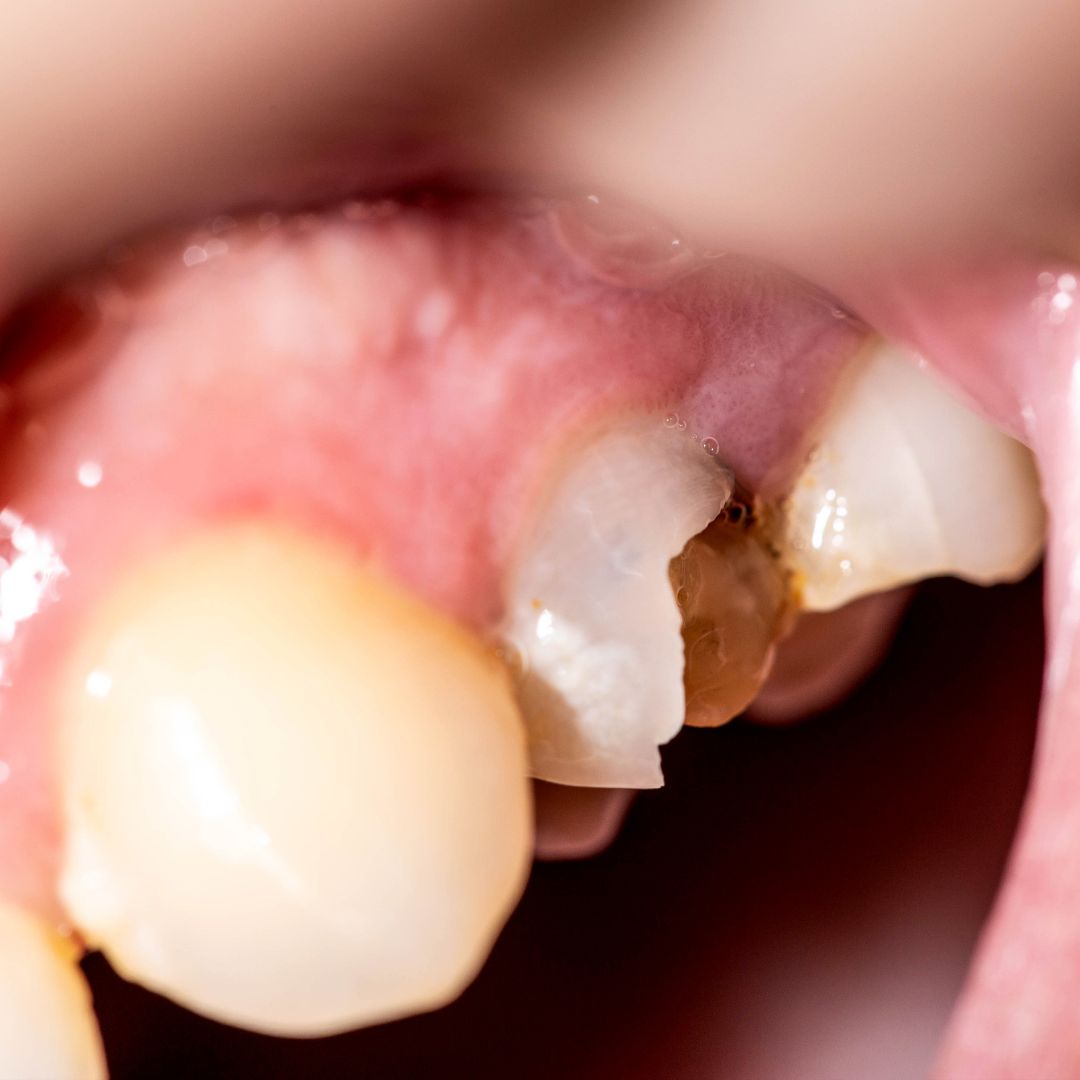 Chipped front tooth needing a filling